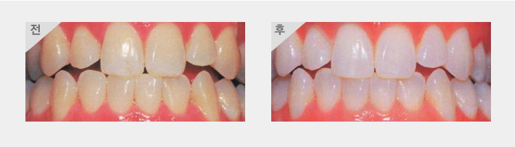 치아미백 전후 사진